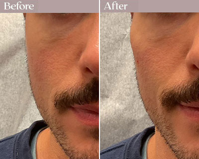 cheek fillers before after nyc